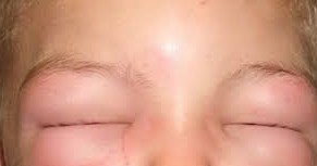 L'oedème de Quincke - Actualités - Sante-dz